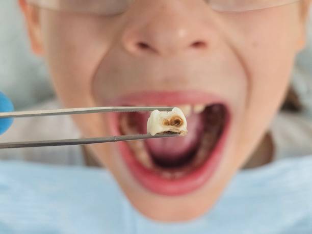 Best Emergency Wisdom Teeth Removal in Trenton, NJ